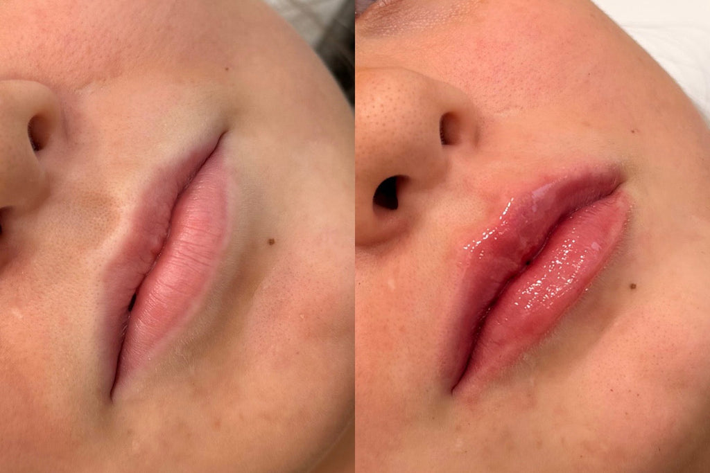 Lip-filler