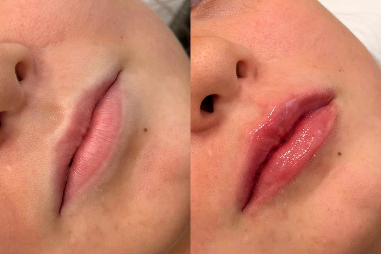 Lip-filler