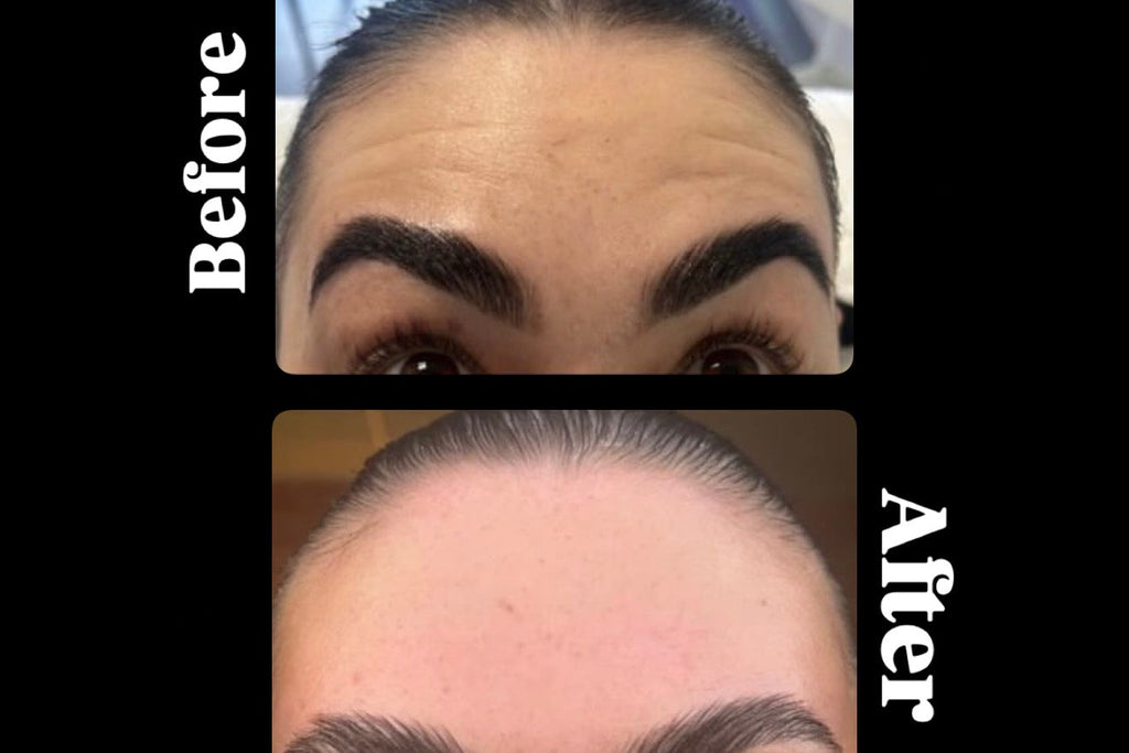Anti-Wrinkle Injections