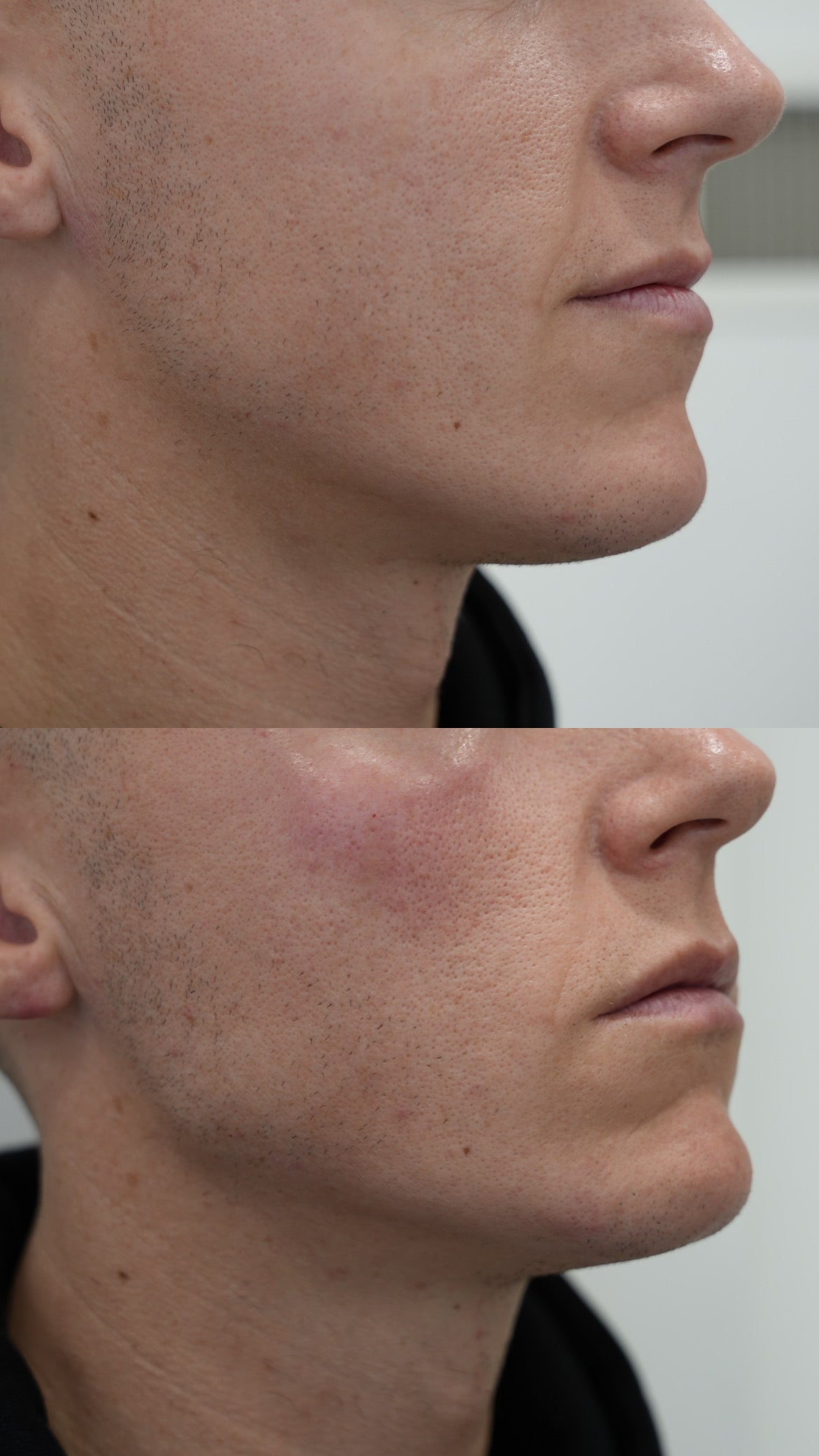 Facial filler