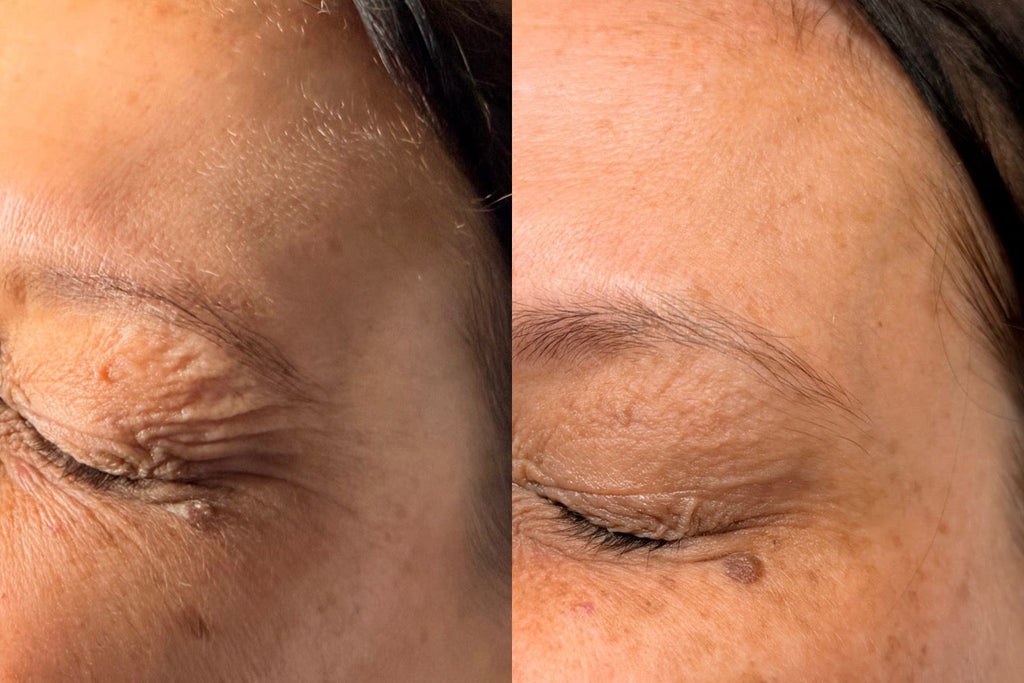 Anti-Wrinkle Injections