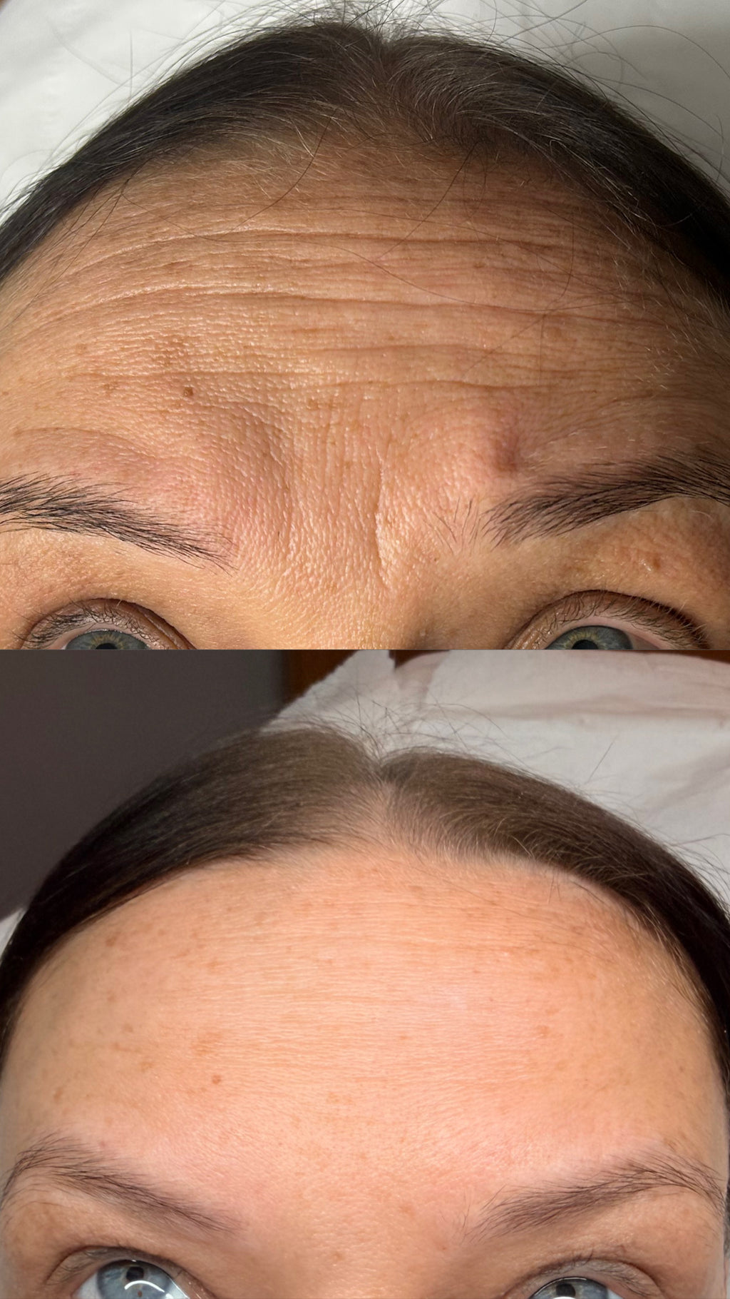 Anti-Wrinkle Injections