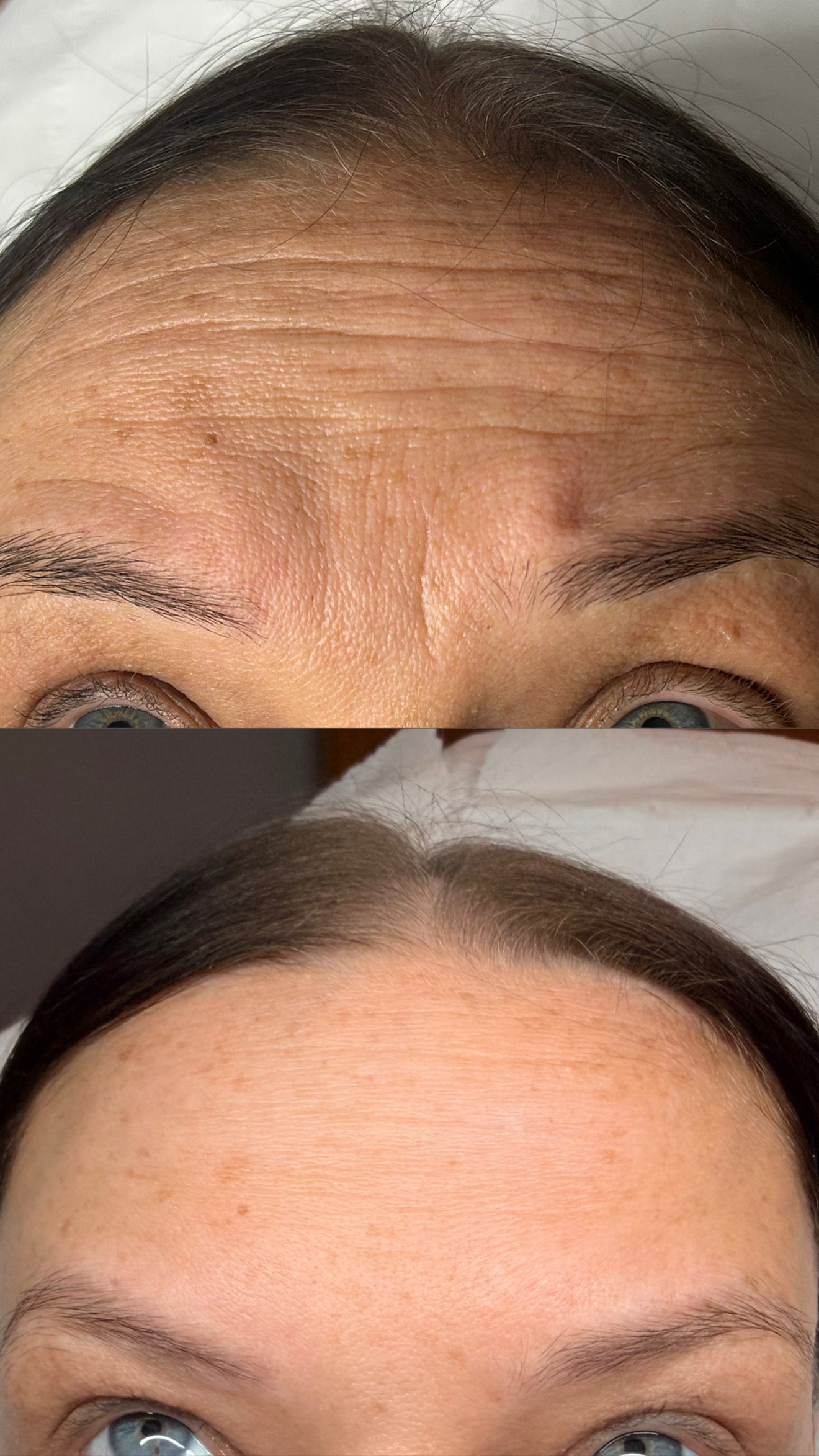 Anti-Wrinkle Injections