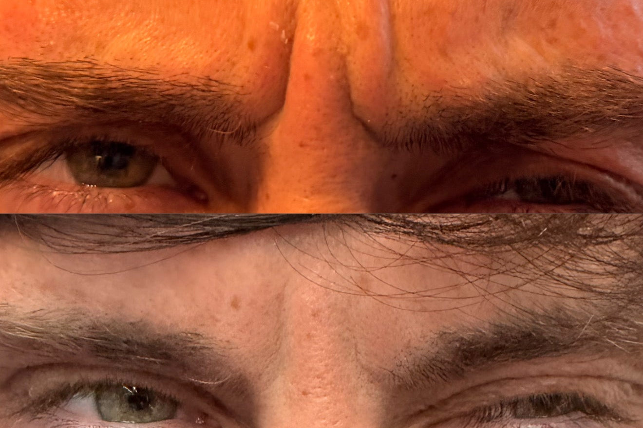 Anti-Wrinkle Injections