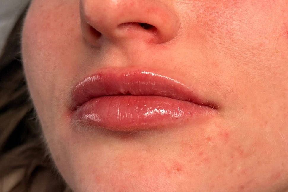 Lip-filler