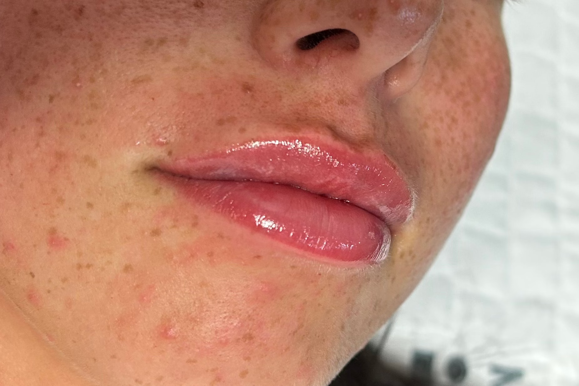 Lip-filler