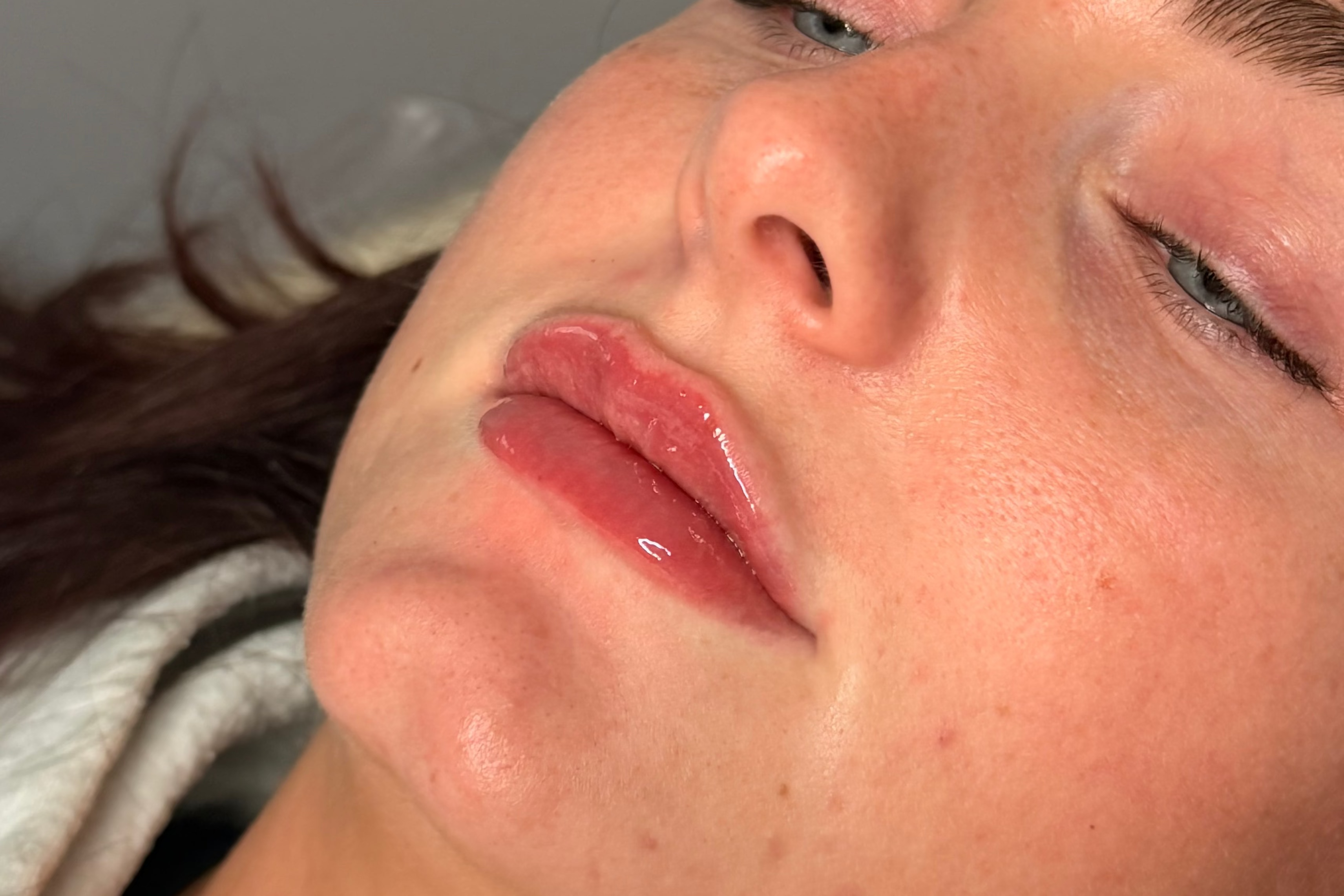 Lip-filler