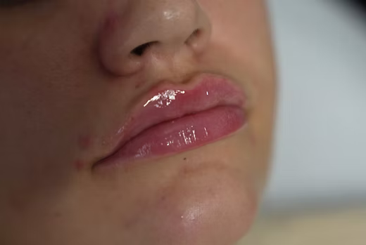 Lip-filler